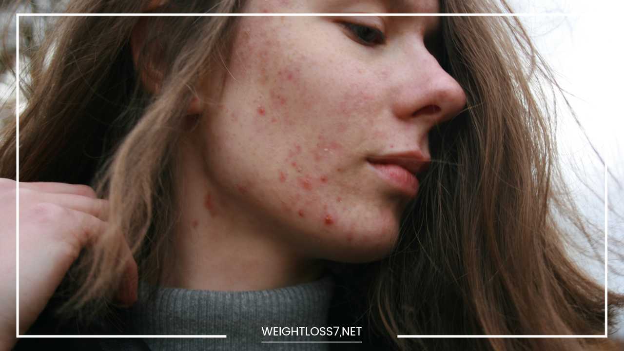 Cystic Acne