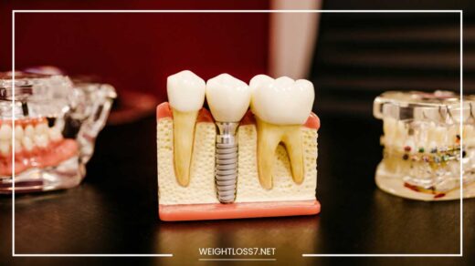 Dental Implants