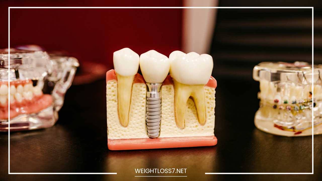 Dental Implants 